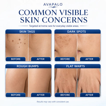 𝟕-𝐃𝒂𝘆 𝐒𝗸𝐢𝐧 𝐓𝒂𝗴 & 𝐒𝐩𝙤𝐭 𝐄𝐫𝒂𝐬𝙚𝐫 Painless & Scar-Free Advanced Imperfection Removal Rollerball Pen