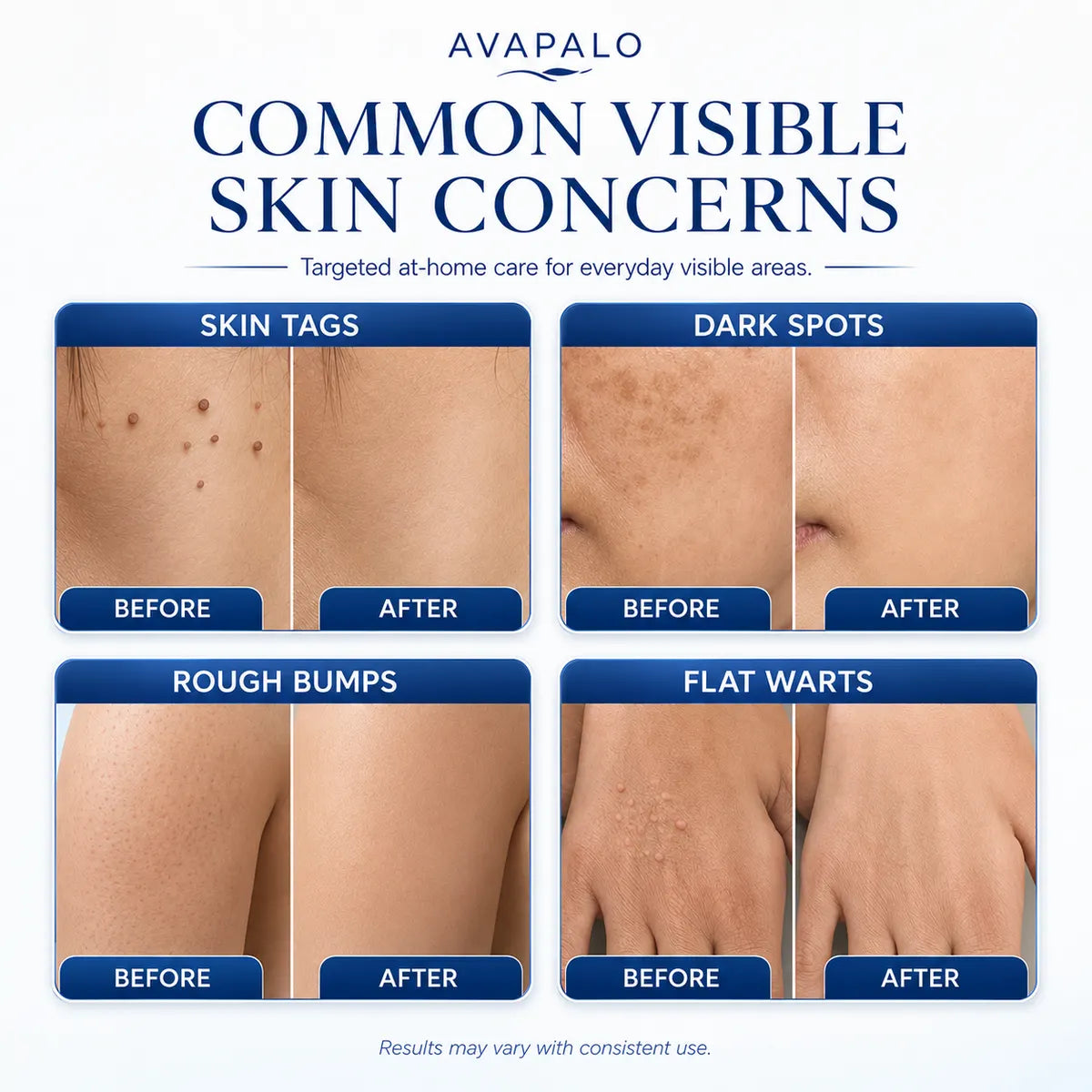 🆙𝟕-𝐃𝒂𝘆 𝐒𝗸𝐢𝐧 𝐓𝒂𝗴 & 𝐒𝐩𝙤𝐭 𝐄𝐫𝒂𝐬𝙚𝐫 Painless & Scar-Free Advanced Imperfection Removal Rollerball Pen