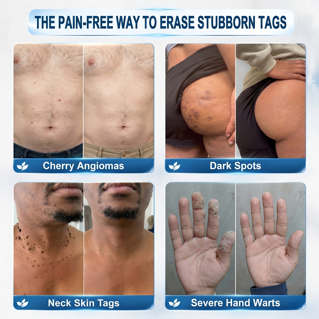 ✨Effective MicroNeedle BotanicSkinTag Removal Patch