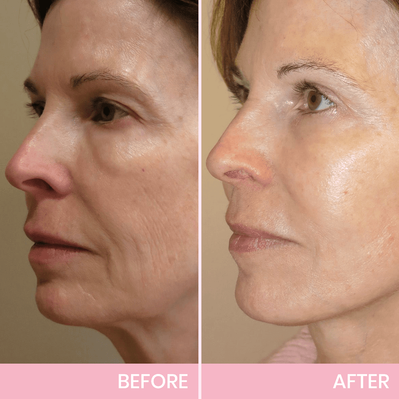 ✨ V-Face Lifting Tape – Instant Jawline Lift & Slim Look
