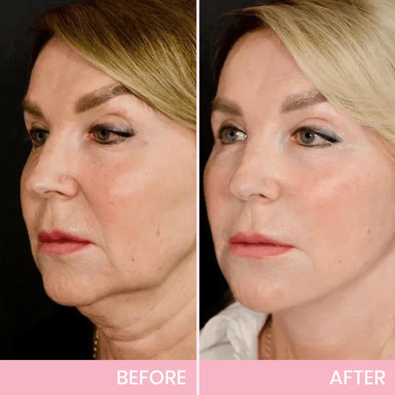 ✨ V-Face Lifting Tape – Instant Jawline Lift & Slim Look