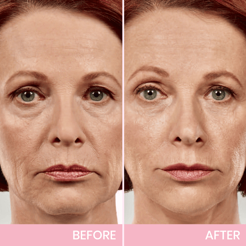 ✨ V-Face Lifting Tape – Instant Jawline Lift & Slim Look