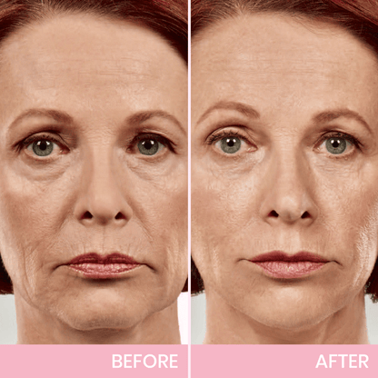 ✨ V-Face Lifting Tape – Instant Jawline Lift & Slim Look